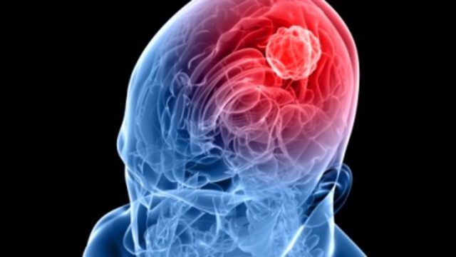 meningite 2