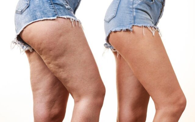 get rid of cellulite naturally