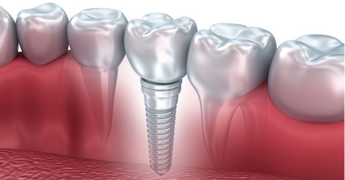 Implantologia dentale