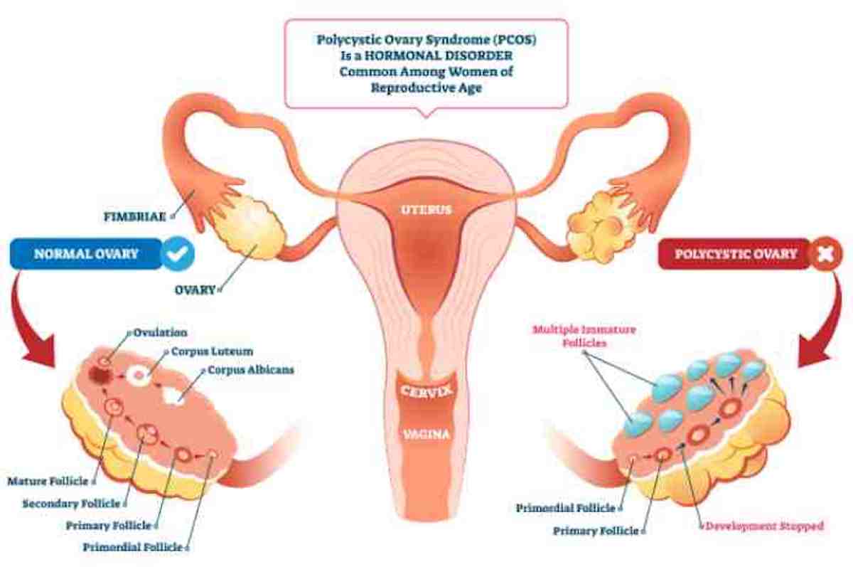 sindrome dell’ovaio policistico
