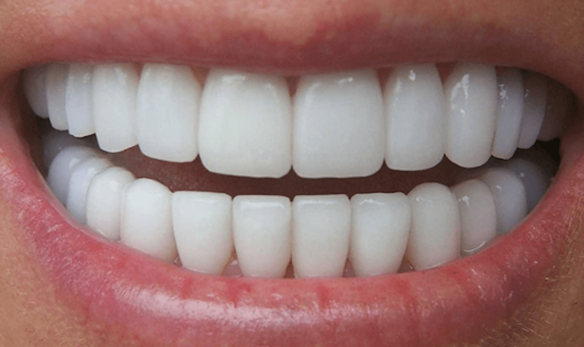 corone in zirconia