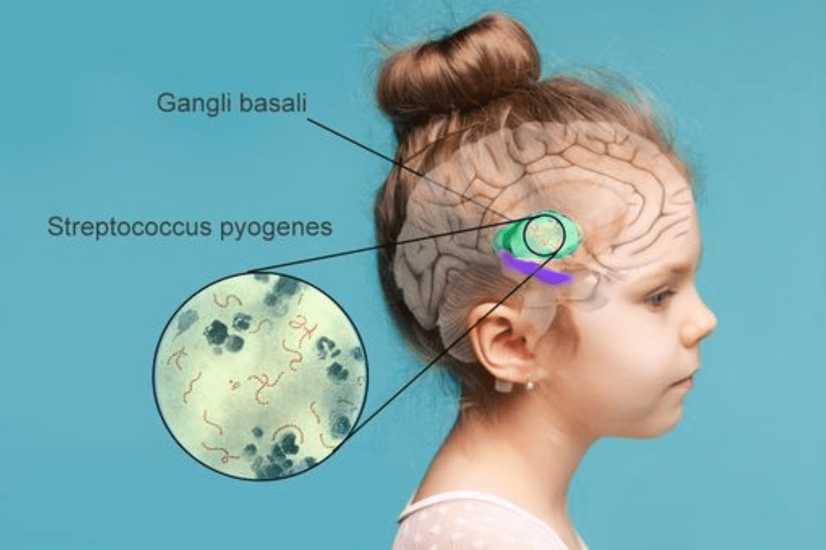 sindrome di pandas