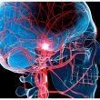 Ictus