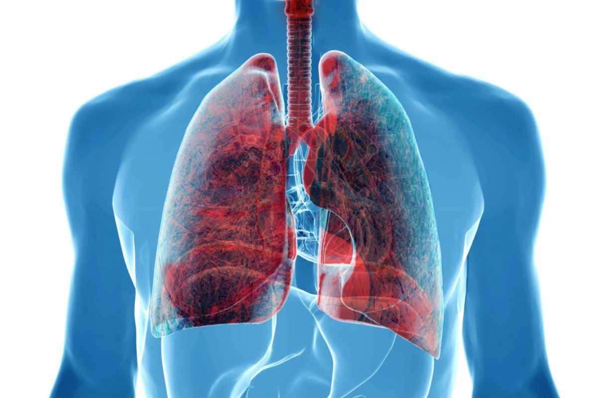 Scambiano il tumore al polmone per la tubercolosi: indagato lo pneumologo di un ospedale di Roma